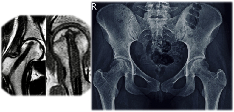 Hip Arthroscopy And Core Decompression For Avascular Necrosis Of The