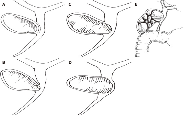 Mirizzi Syndrome History Current Knowledge And Proposal Of A