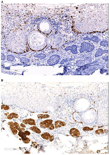 Synchronous Occurrence Of Odontogenic Keratocyst And Ameloblastoma A