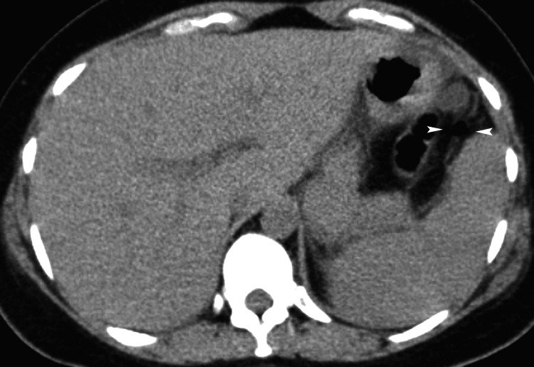 Splenic Rupture In An Elective Cesarean Section A Possible Iatrogenic