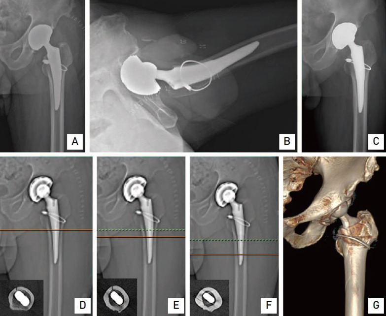 Periprosthetic Occult Femoral Fracture An Unknown Side Effect Of Press