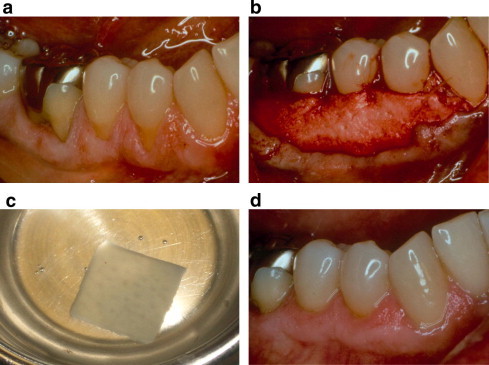 Surgical Management Of Gingival Recession A Clinical Update PMC