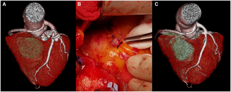 Interpretation Of Coronary Steal Syndrome And Haemodynamic Changes