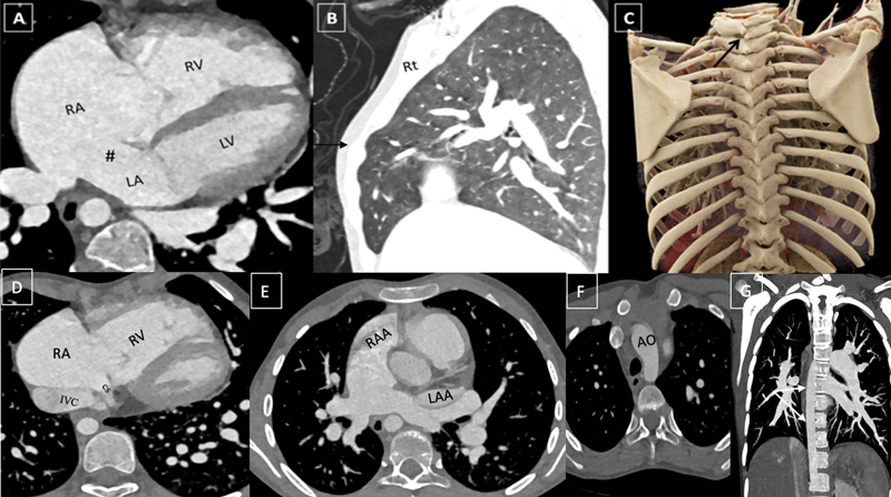 Total Anomalous Pulmonary Venous Connection With Rare Direct Right