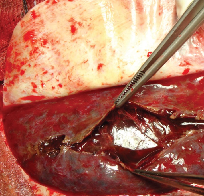 Primary Enlarged Craniotomy In Organized Chronic Subdural Hematomas Pmc