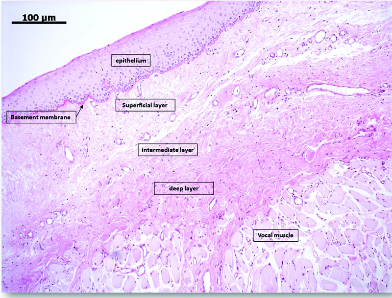 Reinke Edema Factors That Interfere With Vocal Recovery After Surgery