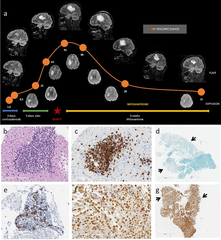 Marburg Multiple Sclerosis Variant Complete Remission With Very Early