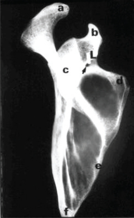 Ossification Of Superior Transverse Scapular Ligament And Its Clinical