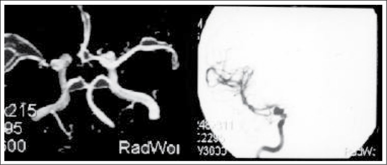 Comparison Between 3D TOF Magnetic Resonance Angiography And