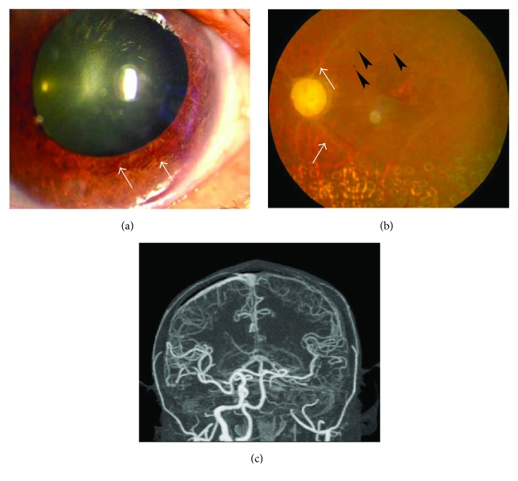 Clinical Analysis Of 42 Cases Of Ocular Ischemic Syndrome PMC