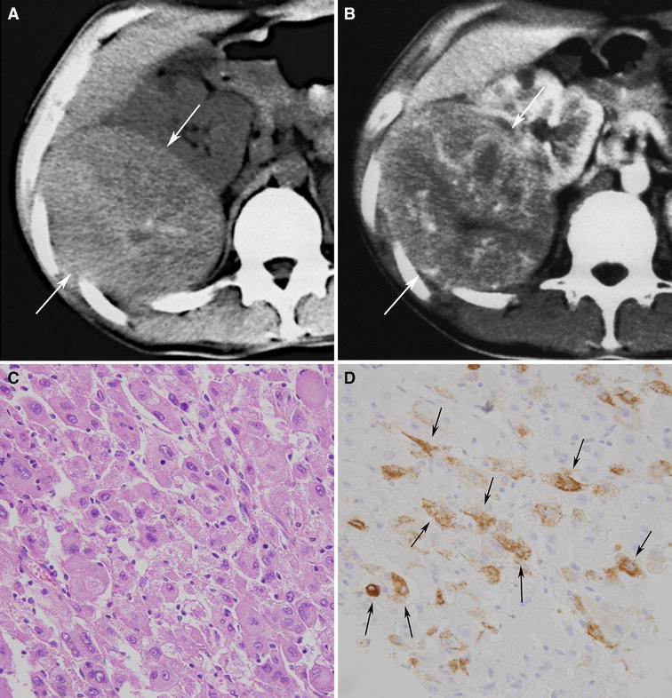 Renal Angiomyolipoma A Radiological Classification And Update On