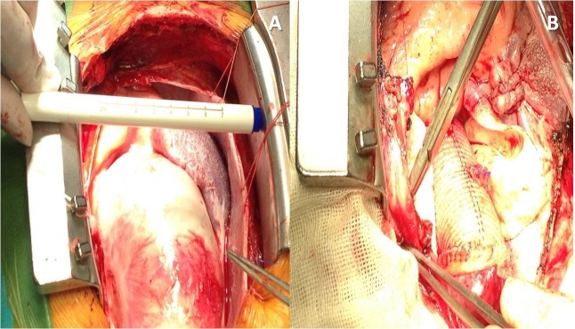 Marfan Syndrome Acute Aortic Dissection Due To Giant Aortic Aneurysm