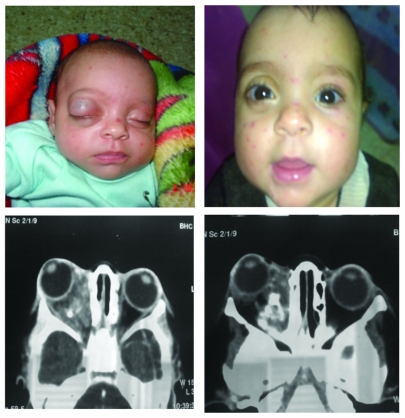 Nonselective Blocker Propranolol For Orbital And Periorbital