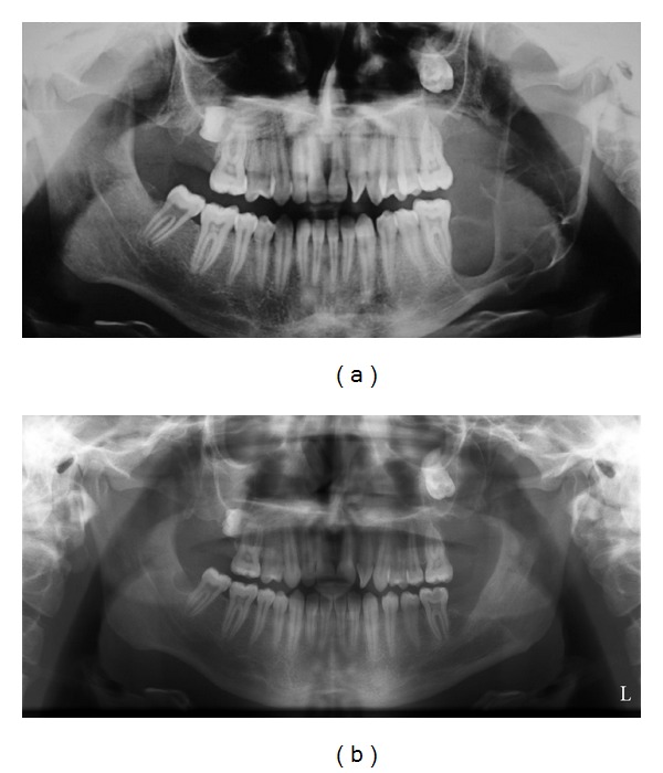 Conservative Management Of Keratocystic Odontogenic Tumors Of Jaws PMC