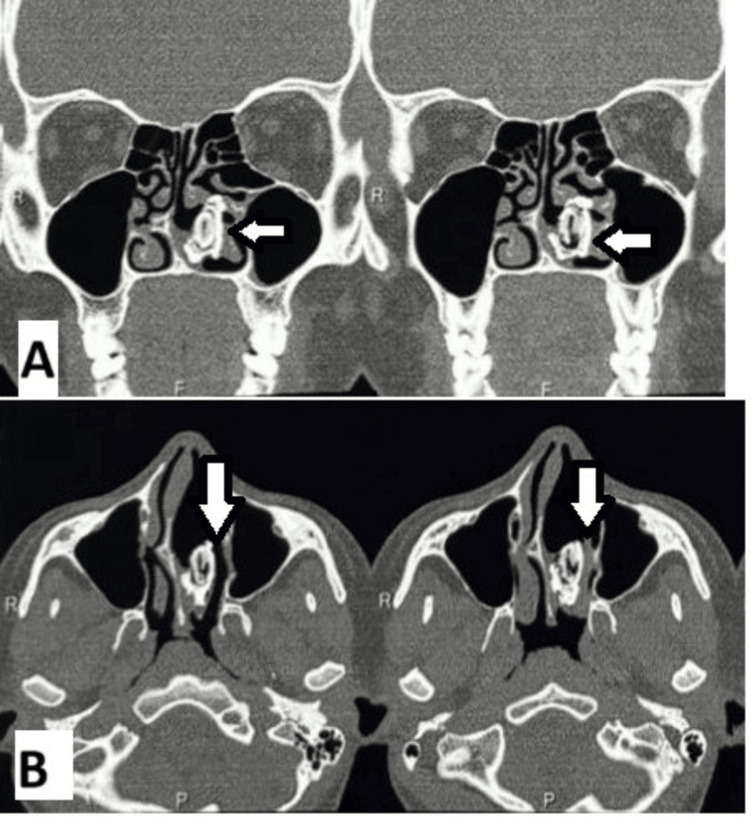 Rhinitis Caseosa A Forgotten Entity PMC