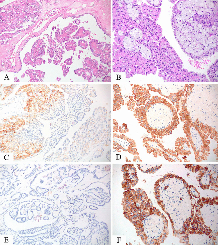 Tfe And Tfeb Rearranged Renal Cell Carcinomas An Immunohistochemical