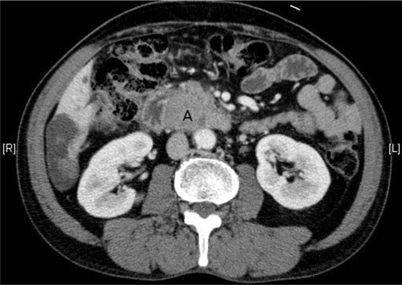 Intraductal Papillary Mucinous Neoplasm Of The Biliary Tract With