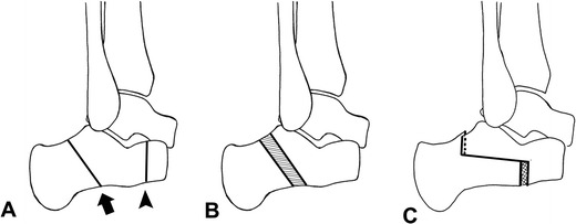 Calcaneus Osteotomy PMC