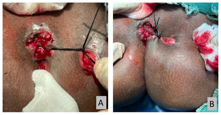 The Value Of Cutting Seton For High Transsphincteric Anal Fistula In