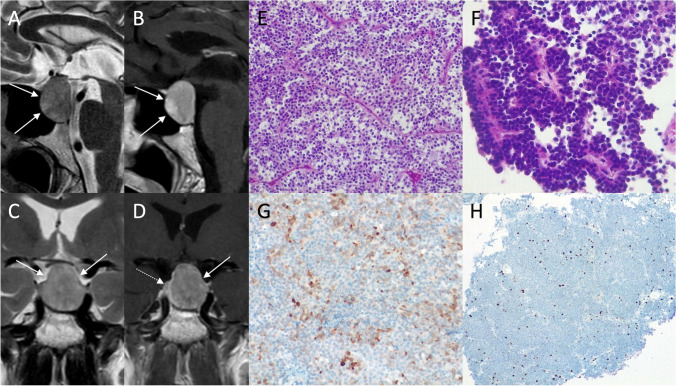 Neoplasms And Tumor Like Lesions Of The Sellar Region Imaging Findings