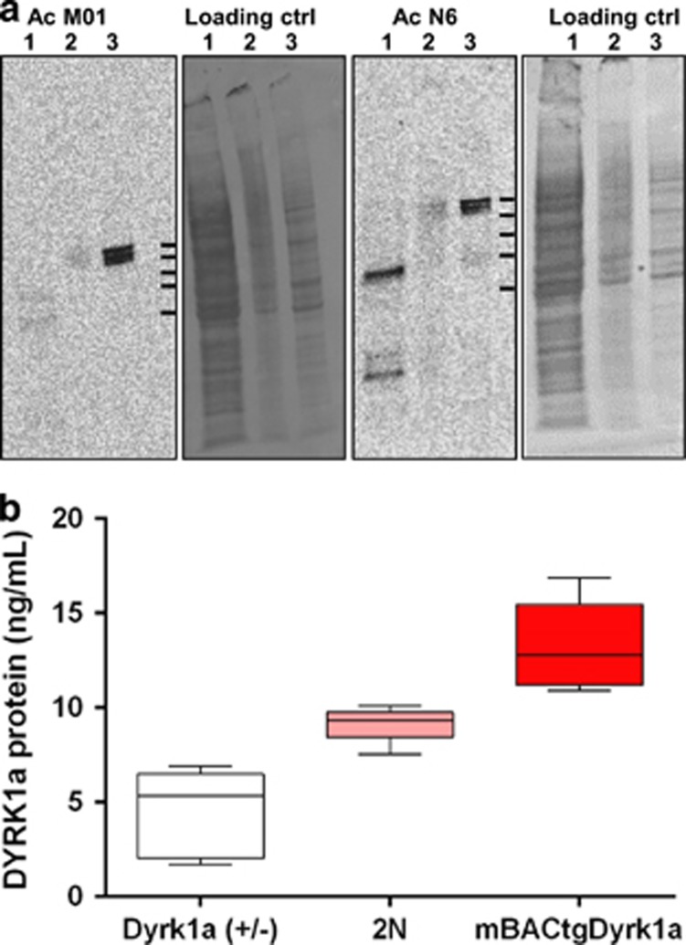 Combined Assessment Of DYRK1A BDNF And Homocysteine Levels As