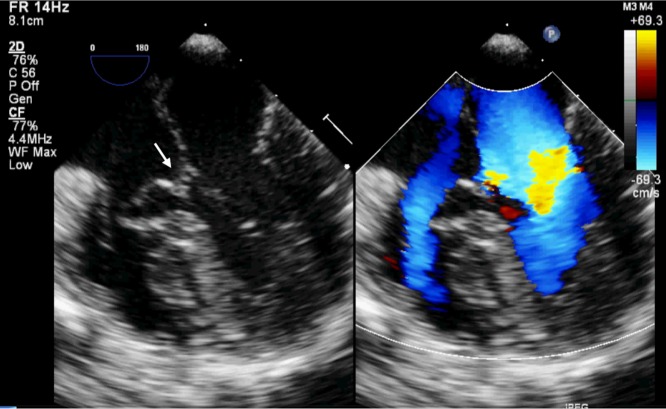 Double Outlet Right Atrium With Three Atrioventricular Valves Pmc