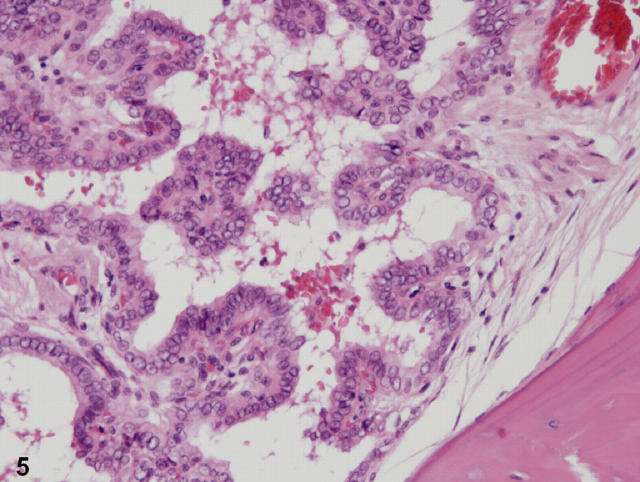 Papillary Carcinoma Of The Thyroid In Japan Subclassification Of