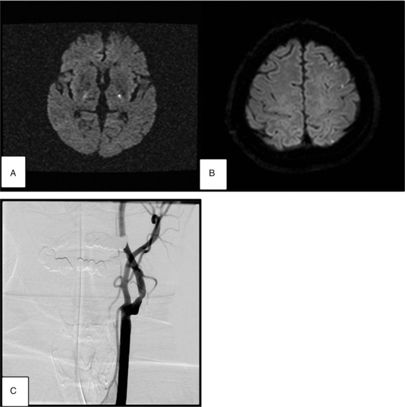 Swallowing Apraxia In A Patient With Recurrent Ischemic Strokes A Case