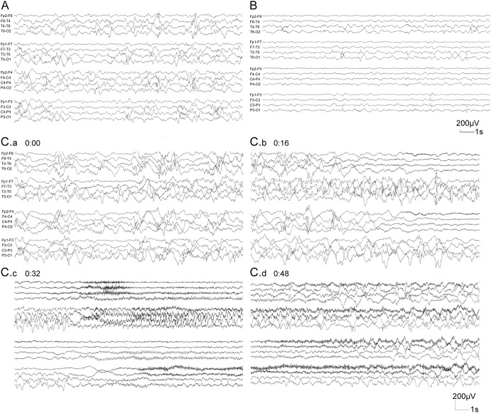 SCN2A Encephalopathy A Major Cause Of Epilepsy Of Infancy With