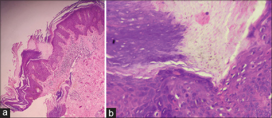 Linear Systematized Porokeratosisa Rare Case And Dermoscopic Clues To