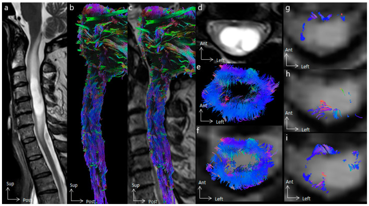 Value Of Spinal Cord Diffusion Imaging And Tractography In Providing