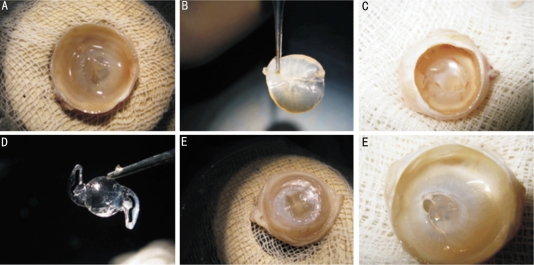 Comparison Of Design Of Intraocular Lens Versus The Material For Pco