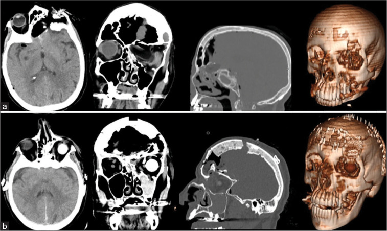 Multi Layer Approach To Complex Traumatic Anterior Skull Base Fracture