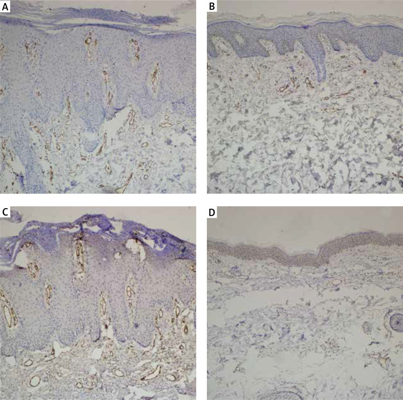 Evaluation Of Microvessel Density With CD31 And CD105 In Patients With