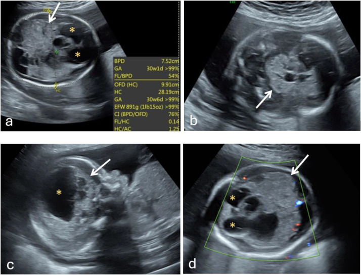 The Prenatal Imaging Of A Rare Congenital Intracranial Teratoma PMC