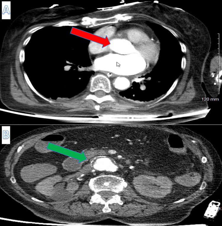 It Is Not Always Diverticular Bleeding Fatal Subtle Primary Aorto