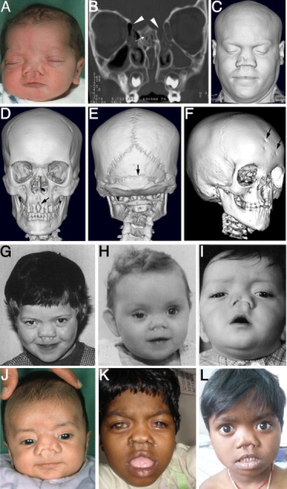 Frontorhiny A Distinctive Presentation Of Frontonasal Dysplasia Caused