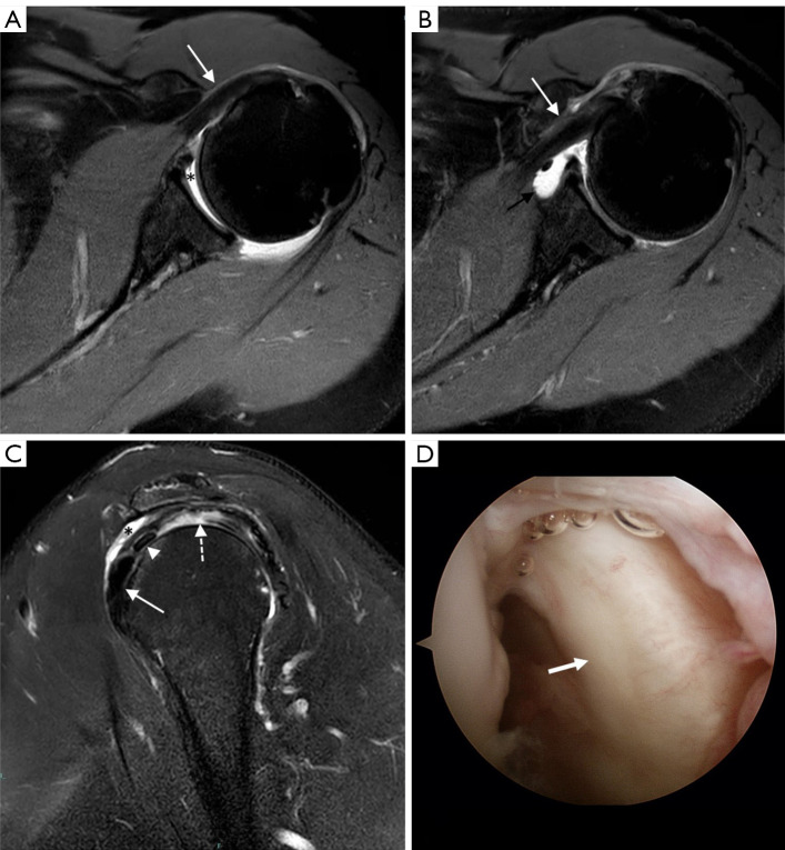 Subscapularis Tendon Tear Detection Using Axial Internal Rotation MRI