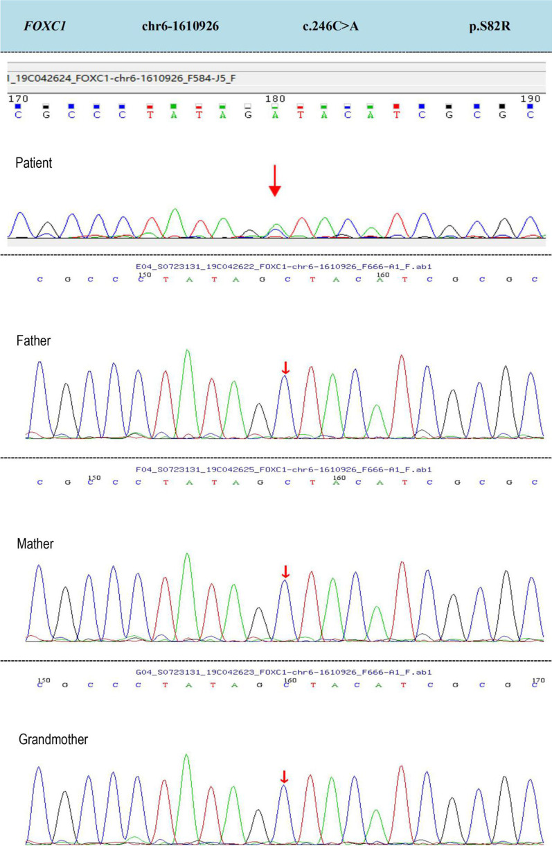 A Novel Missense Mutation Of Foxc In An Axenfeldrieger Syndrome