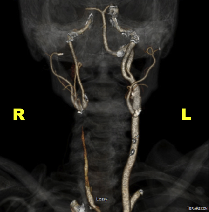 Endarterectomy Of Carotid Artery Bifurcation In The Setting Of A