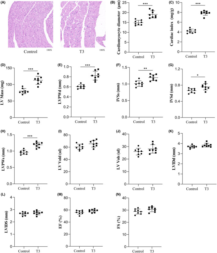 High Triiodothyronine Levels Induce Myocardial Hypertrophy Via BAFF