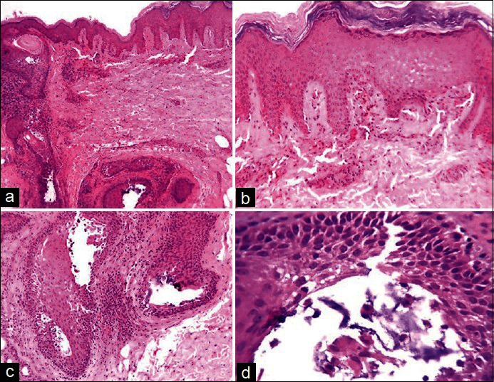 Adult Onset Atopic Dermatitis With Secondary Follicular Mucinosis With