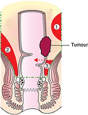 Residual Mesorectum On Postoperative Magnetic Resonance Imaging