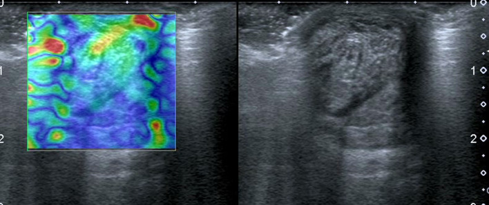 Post Operative Mri And Us Appearance Of The Achilles Tendons Pmc