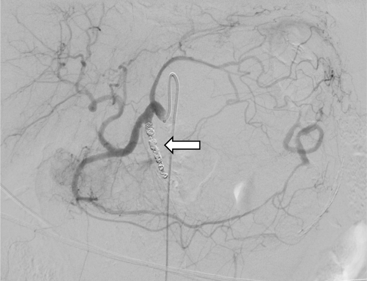 Emergency Endovascular Coiling Of A Ruptured Giant Splenic Artery