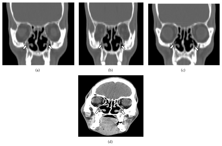 Bilateral Maxillary Sinus Hypoplasia PMC