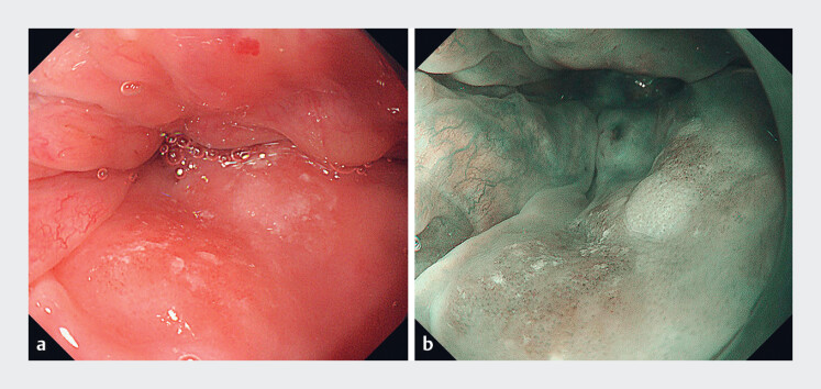 Underwater Endoscopic Submucosal Dissection With Nasal Intubation Using