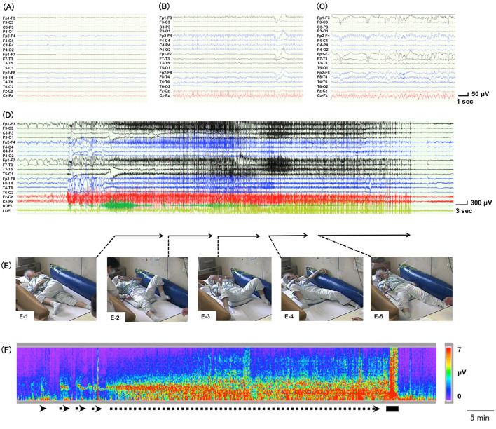 Absence Of An Autonomic Sign Assists In The Diagnosis Of Extratemporal