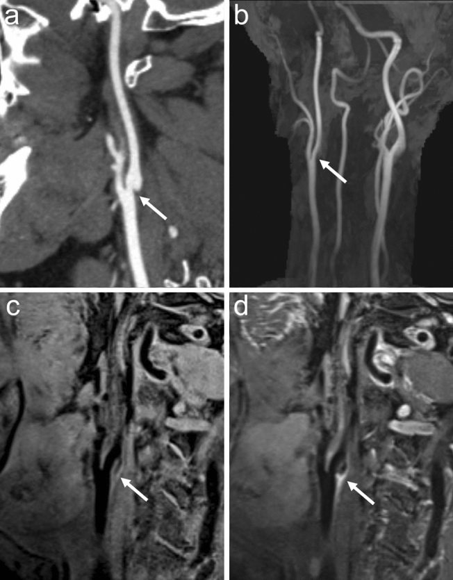 Vessel Wall MR Imaging In Neuroradiology PMC