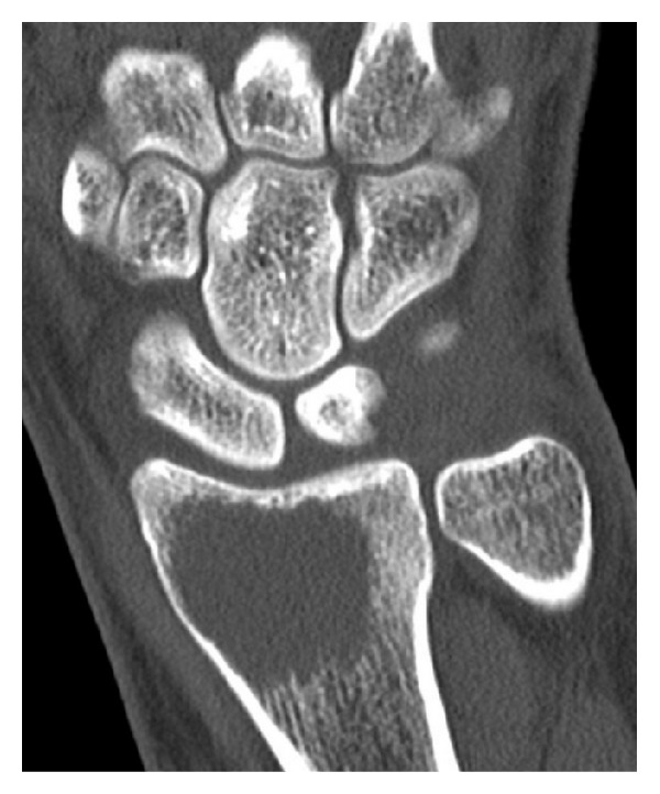 Multicentric Giant Cell Tumor Of Bone Synchronous And Metachronous